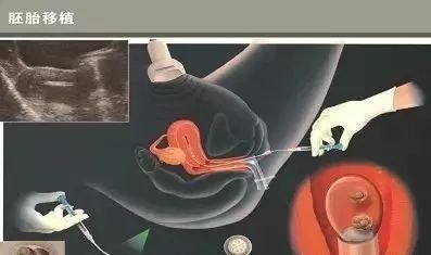 多囊卵巢综合征