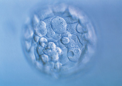 多囊卵巢综合征